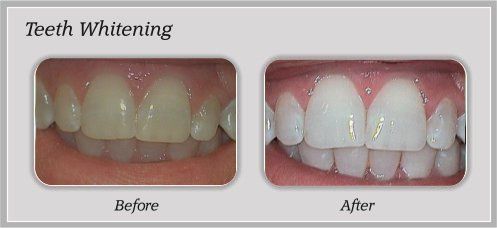 before and after teeth whitening