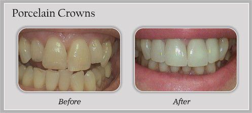 porcelain crowns before and after