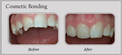 cosmetic bonding before and after