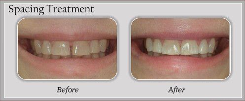 spacing treatment before and after