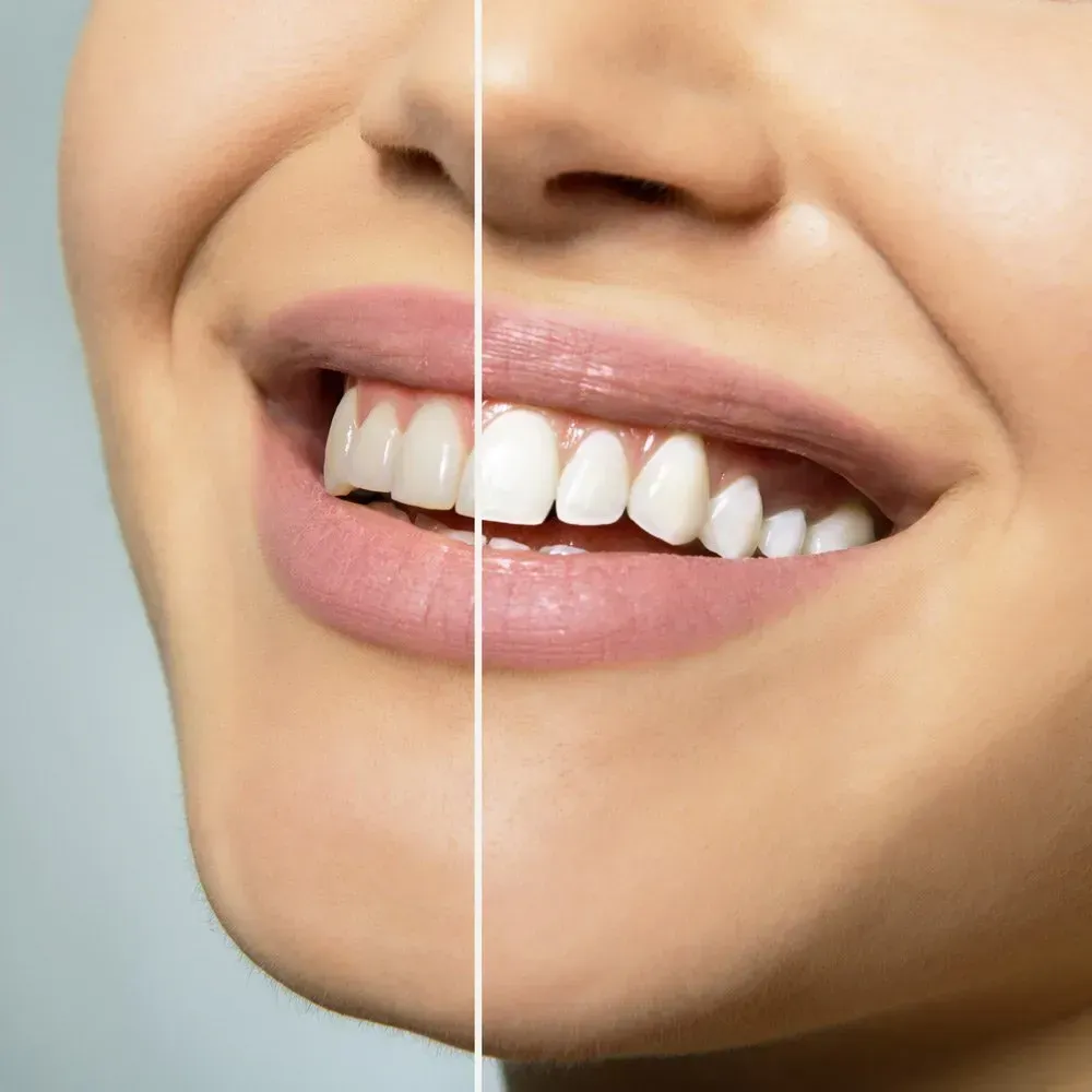 One Side Shows Dull Teeth, the Other Shows Bright, White Teeth — Maitland Dental Care in Maitland, NSW
