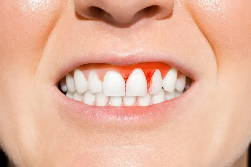 Mouth With Gums Visibly Bleeding — Maitland Dental Care in Maitland, NSW