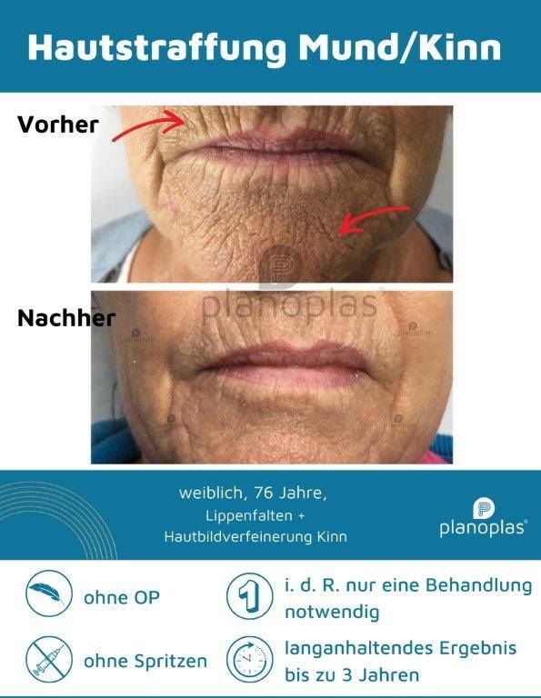 Ein Vorher-Nachher-Foto vom Mund einer Frau