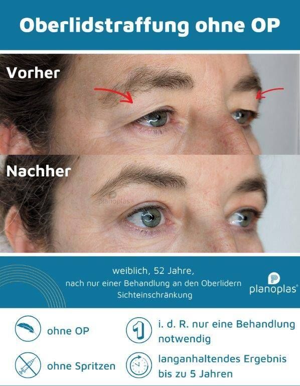 Ein Vorher-Nachher-Foto der Augenbrauen einer Frau