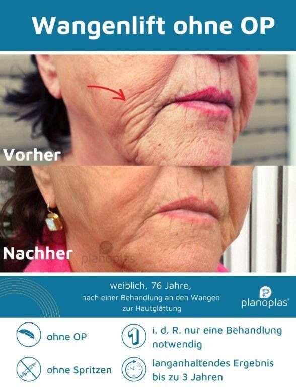 Ein Vorher-Nachher-Foto vom Gesicht einer Frau