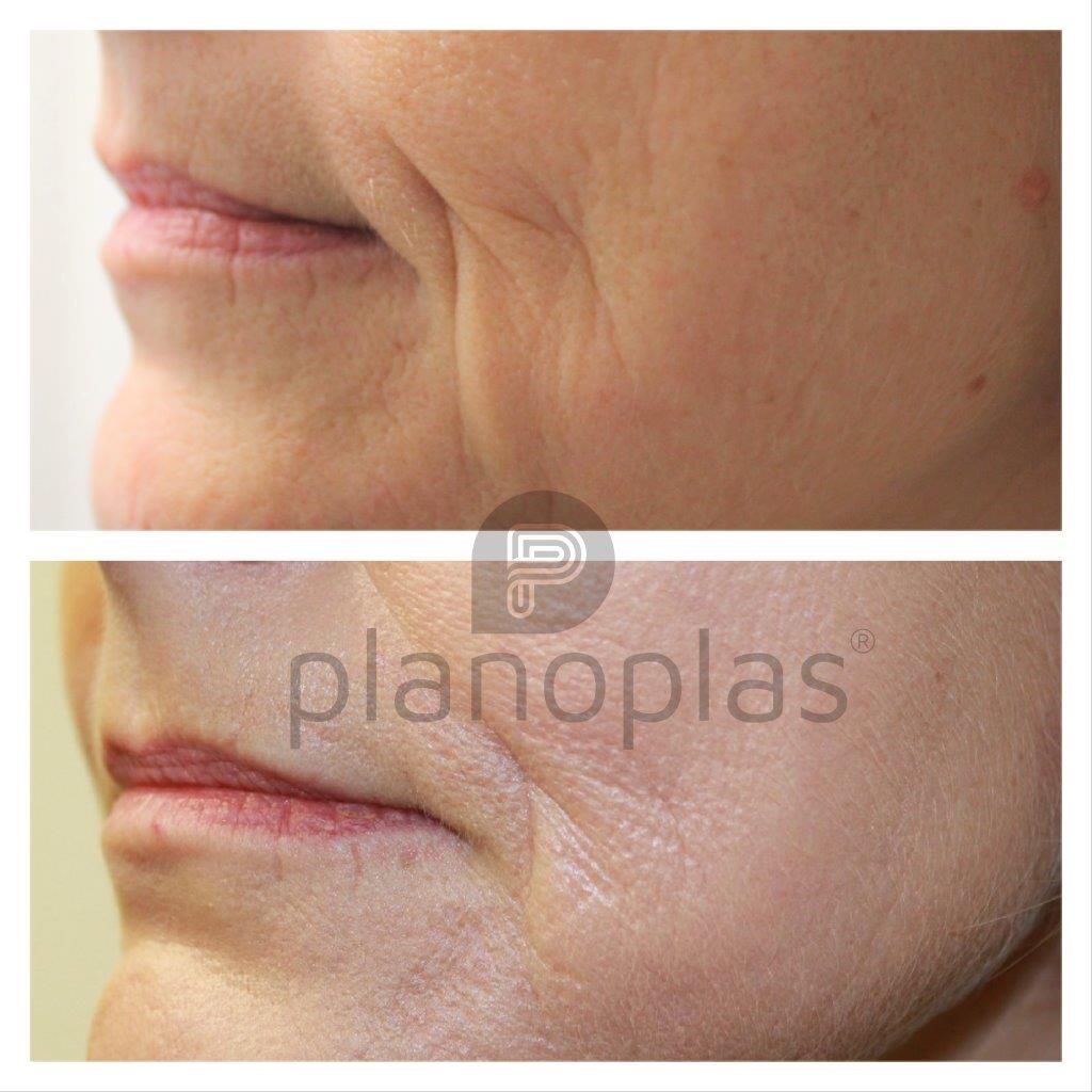 Ein Vorher-Nachher-Foto vom Gesicht einer Frau