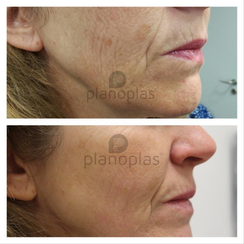 Ein Vorher-Nachher-Foto eines Frauengesichts von planoplas