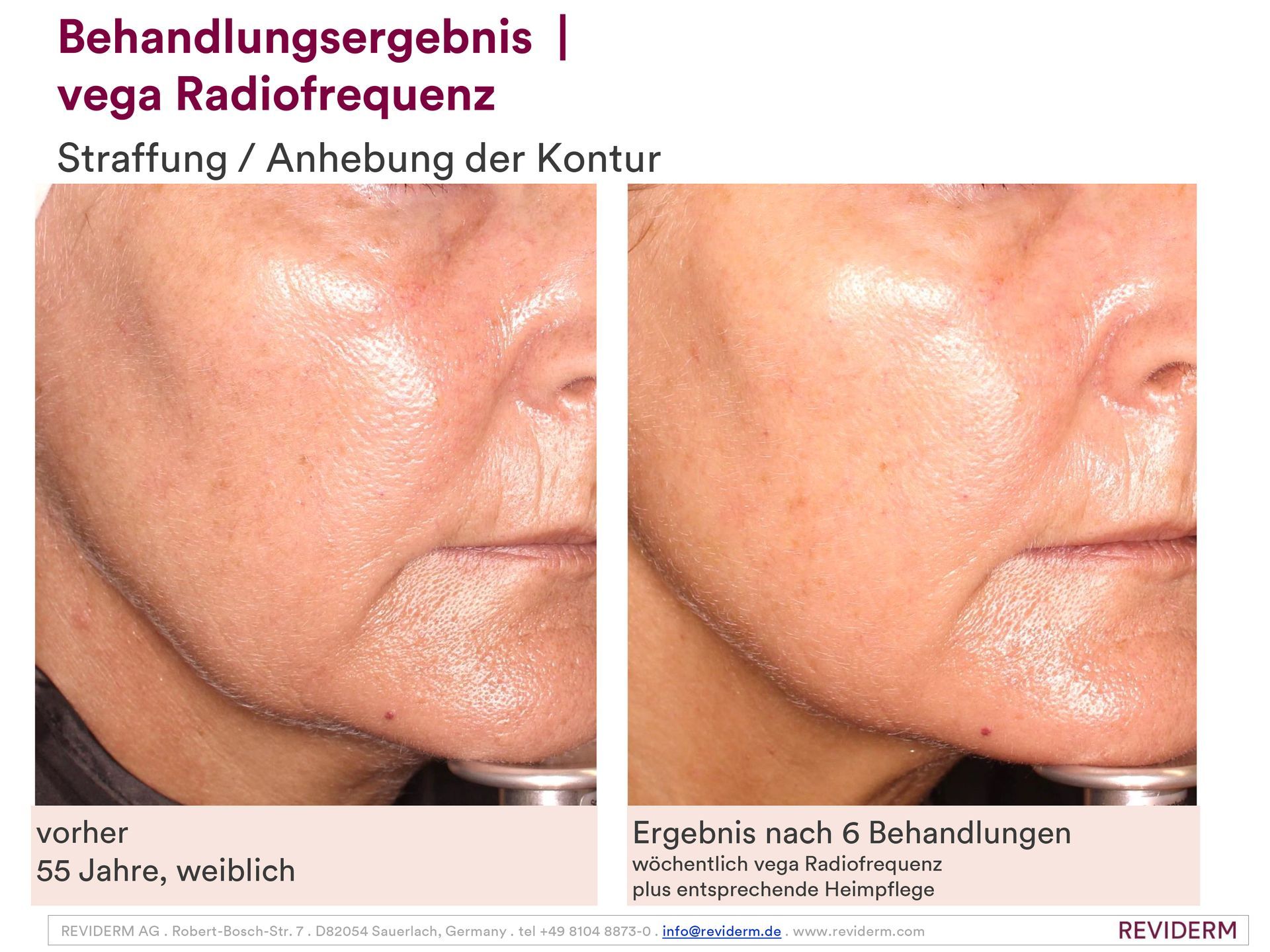 Ein Vorher-Nachher-Foto vom Gesicht einer Frau