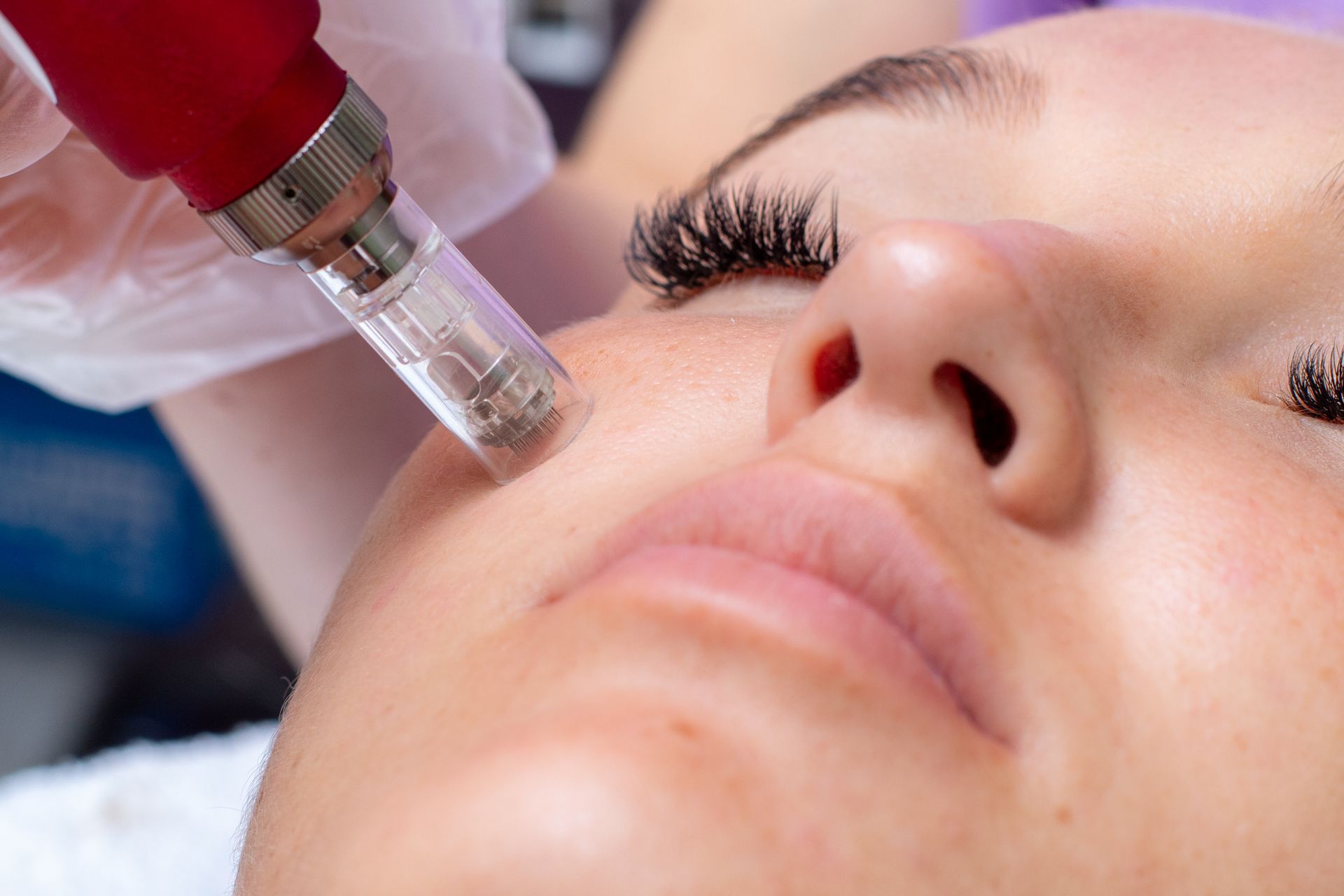 A woman is getting a microneedle treatment on her face.