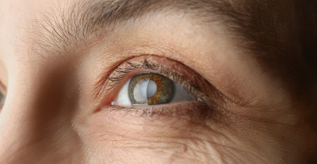 Your Guide to Understanding Cataracts