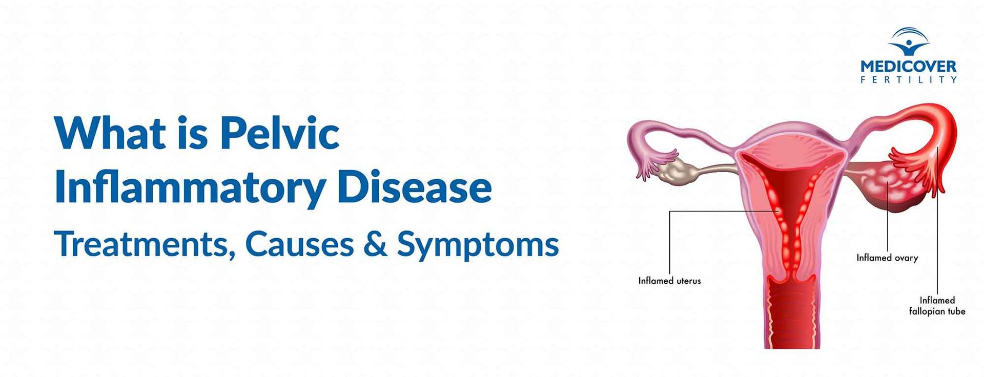 Pelvic Inflammatory Disease Antibiotics