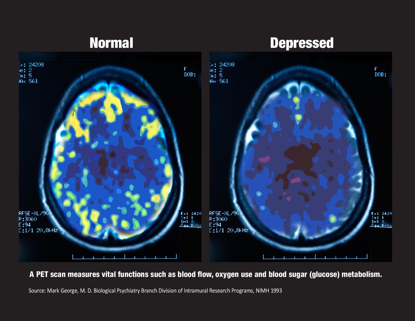 Normal and Depressed Brain Scan — Youngstown, OH — Comprehensive Behavioral Health Associates Inc.