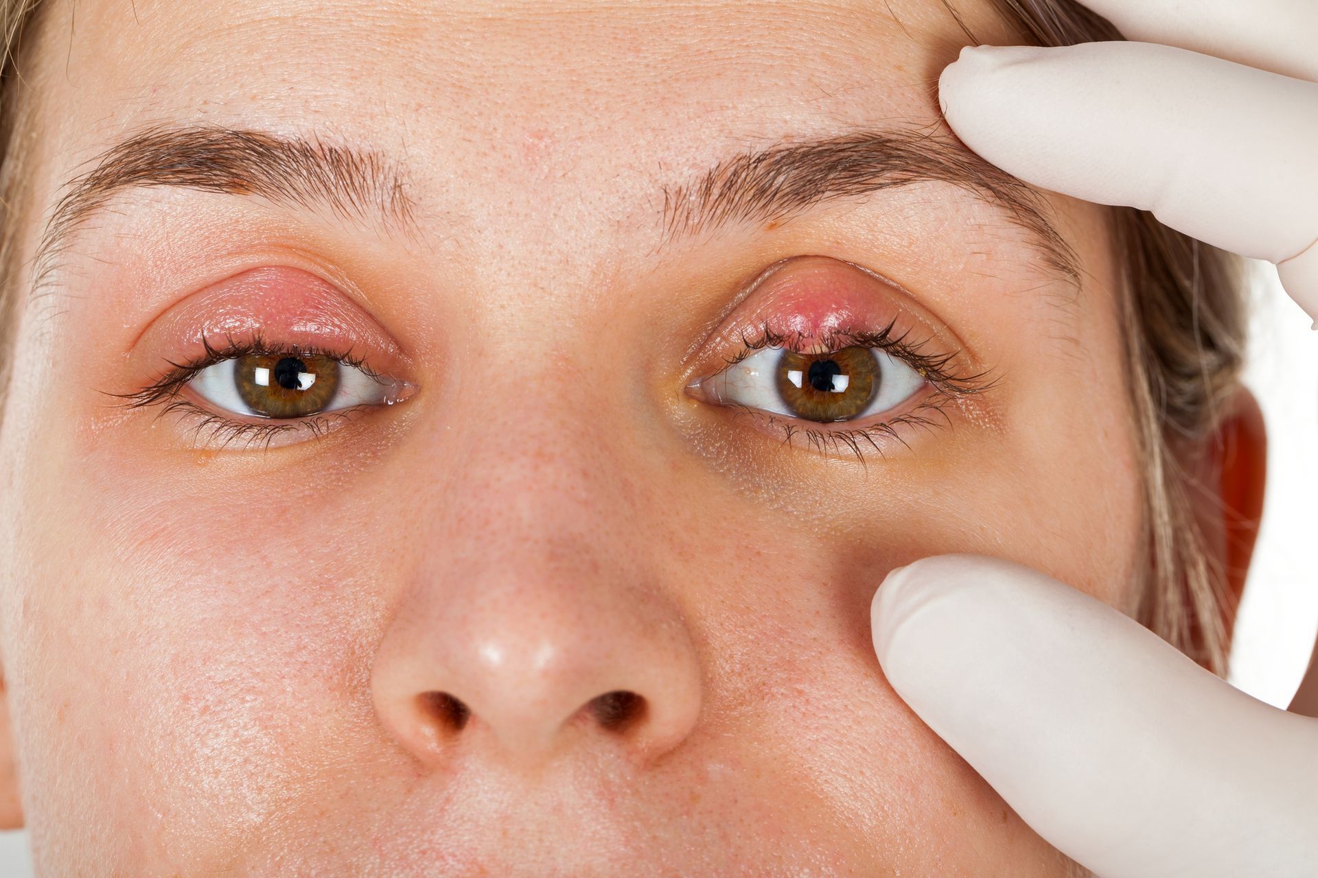 Ophthalmic Infection — Pocatello, ID — Eyecare Of Southeast Idaho