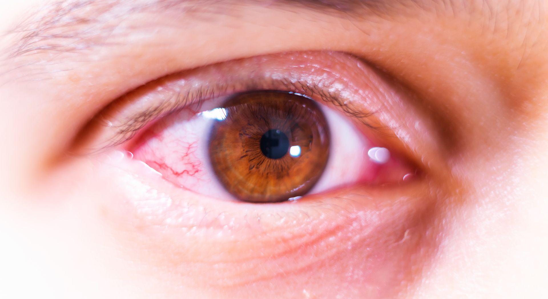  Irritated Brown Eye — Pocatello, ID — Eyecare Of Southeast Idaho
