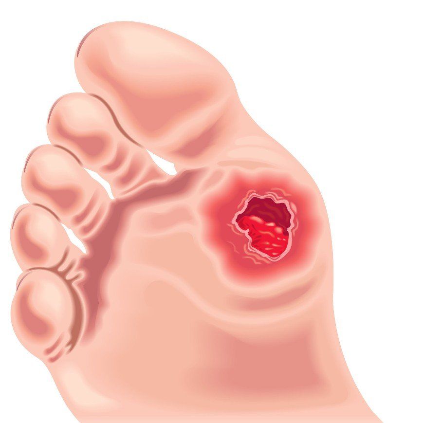 Sores on outlet foot