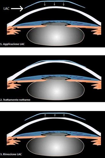 Schema di descrizione delle lenti ortocheratologiche notturne