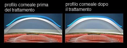 Immagine del prima e dopo il trattamento ortocheratologico