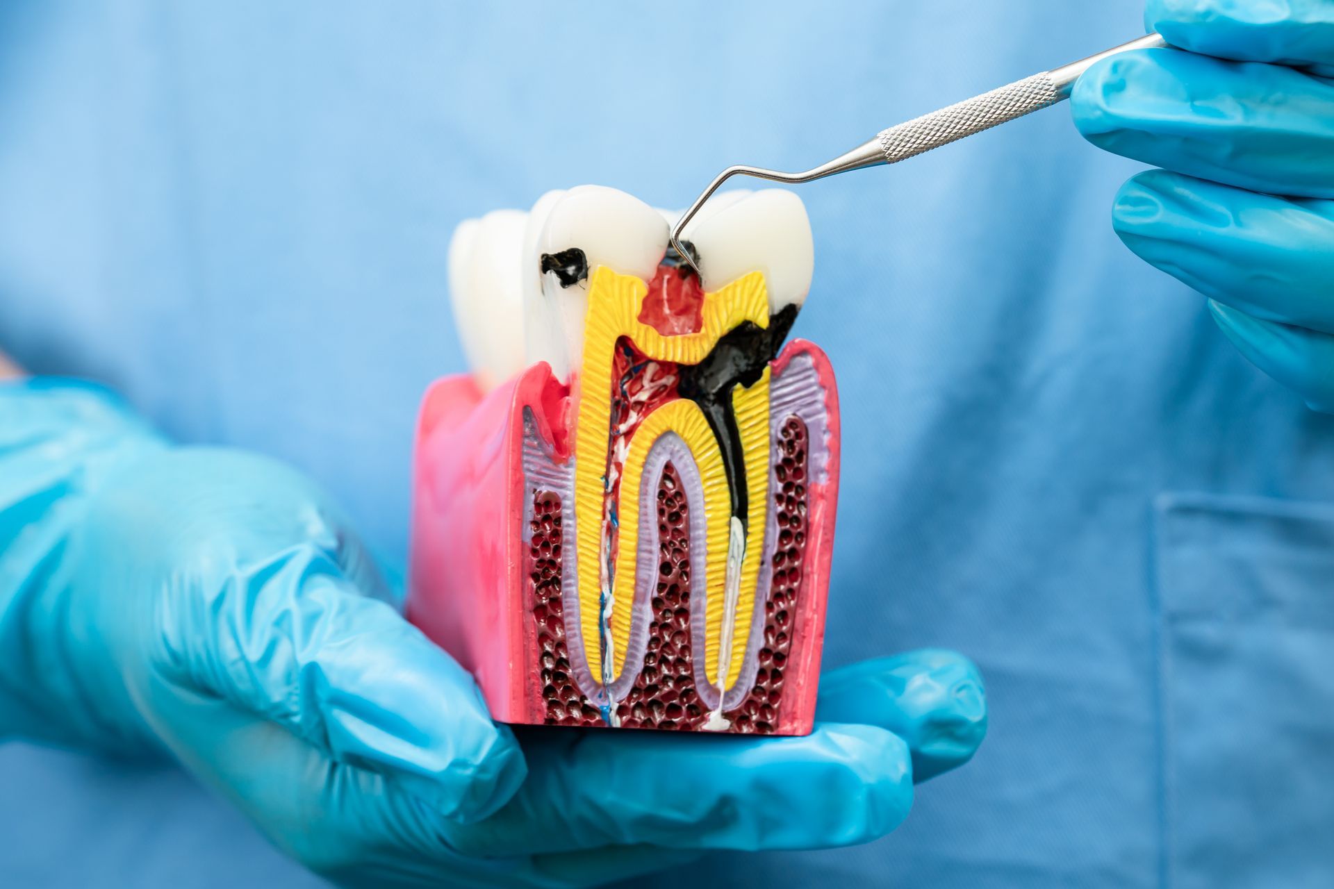 Cross-section model of a tooth with a cavity, held by a person in blue gloves, dental tool points to the damage.