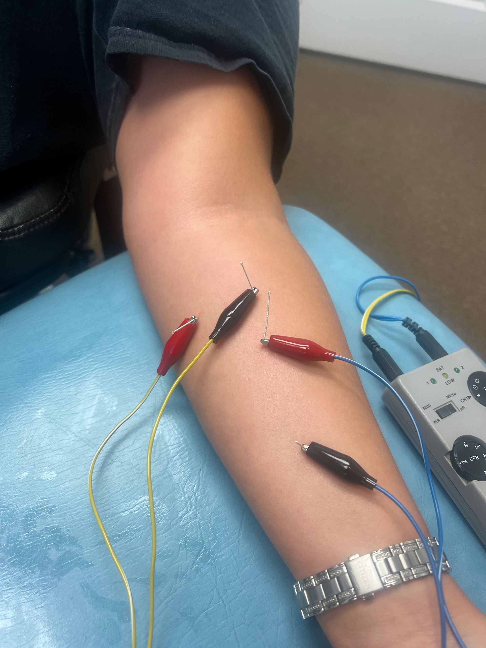 A person wearing blue gloves is getting acupuncture on their arm.