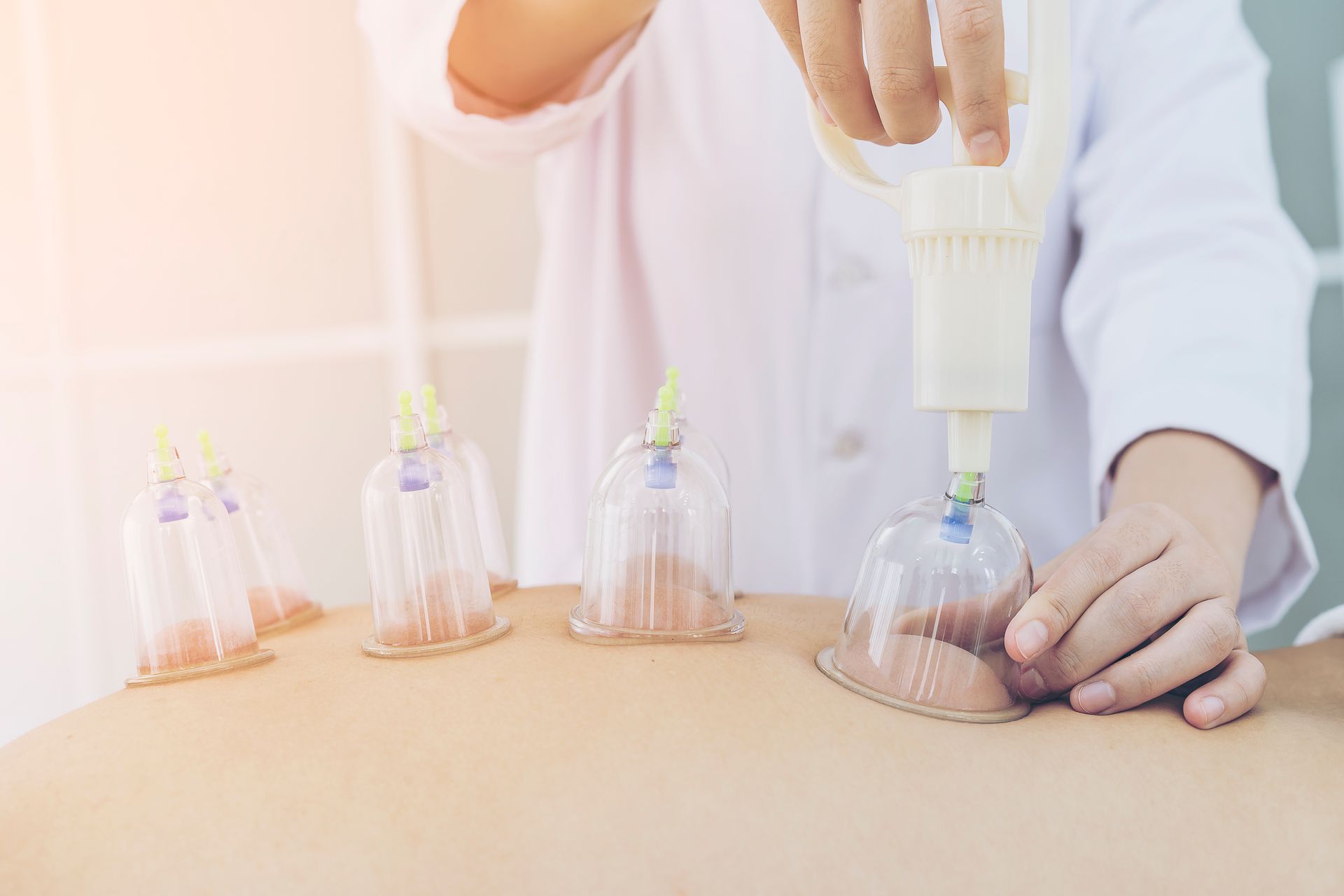 A doctor is giving a cupping treatment to a patient.