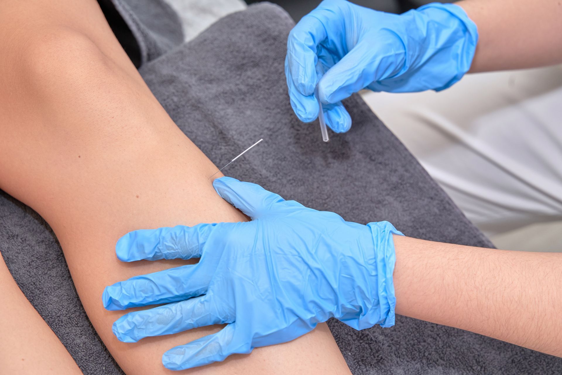 A person wearing blue gloves is getting acupuncture on their arm.