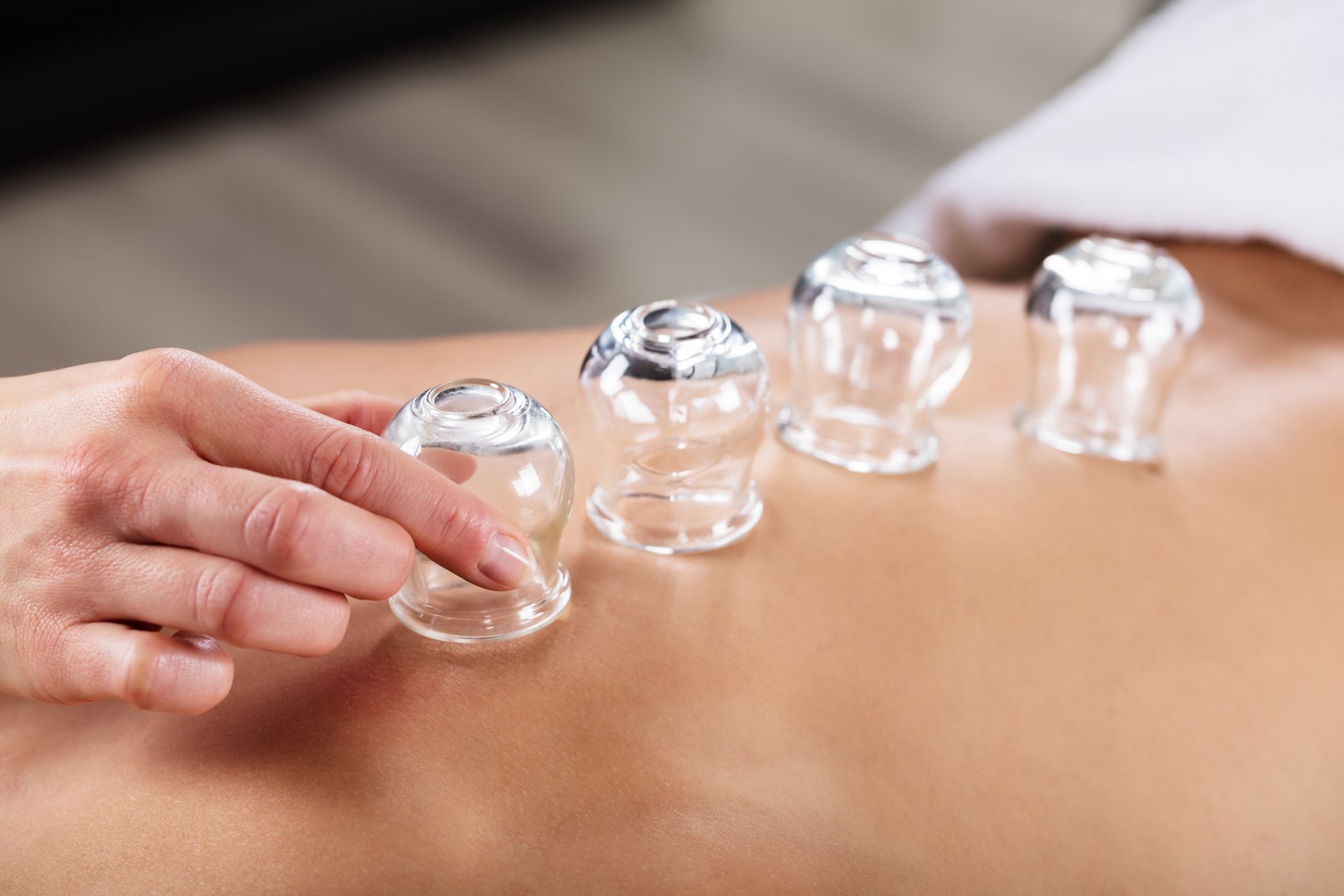 A person is getting cupping treatment on their back.