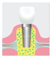 Dental implants in Delta