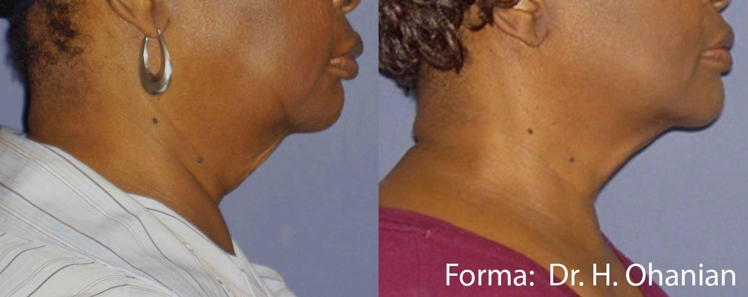 A before and after photo of a woman 's neck and neckline