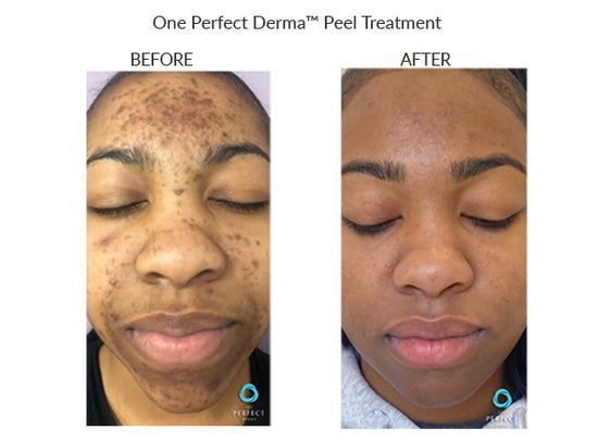 A woman 's face before and after a peel treatment