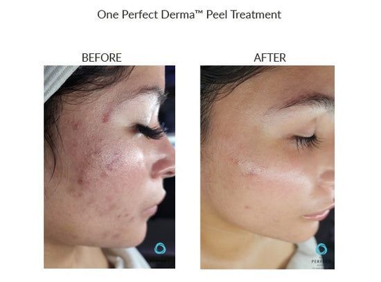 A before and after photo of a woman 's face with acne.