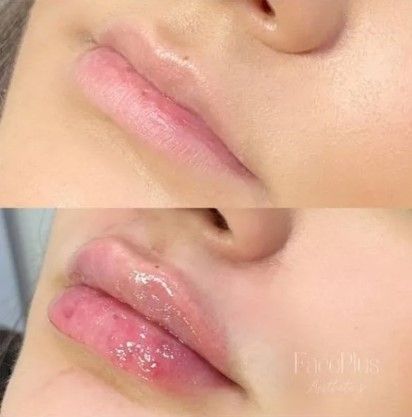 A before and after photo of a woman 's lips.
