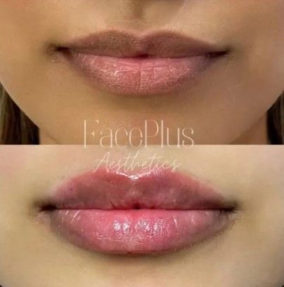 A before and after photo of a woman 's lips.