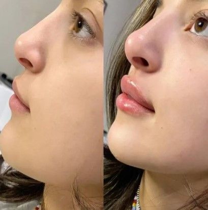 A before and after photo of a woman 's nose and lips.