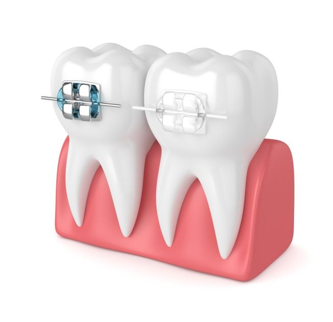 immagine di denti con apparecchio