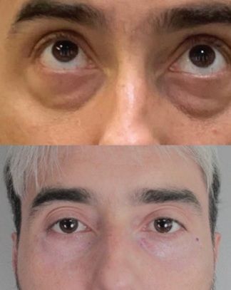 Close-up comparison of eyes: dark circles above, brighter under-eye area below.
