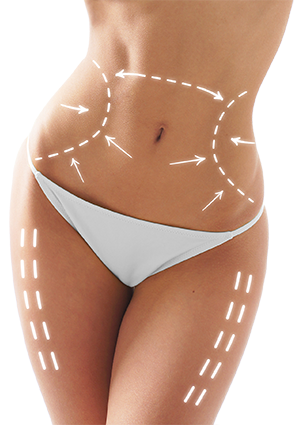 Woman in white bikini with dashed arrows indicating abdomen and waist slimming treatment areas