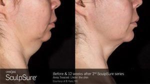 Before and after picture of chin and neck treatment
