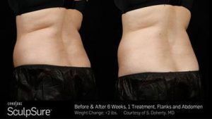 Before and after picture of back fats