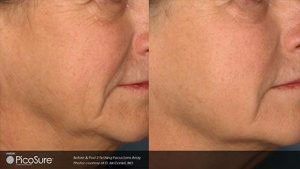 Before and after picture of fine lines and sagging facial muscles