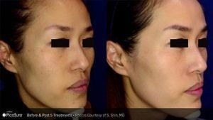 Before and after picture of PicoSure Treatment