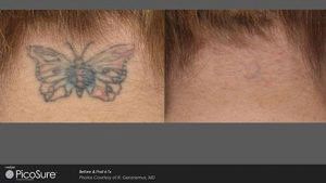 Before and after picture of tattoo removal