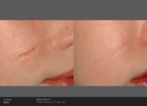 Before and after picture of scar removal