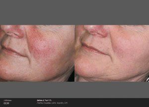 Before and after picture of skin redness treatment