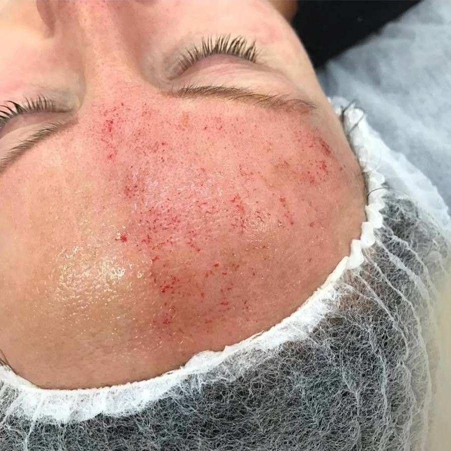 A Close Up Of A Woman 's Face With Red Spots On It — Beauty & Laser by Sarah in Long Jetty, NSW