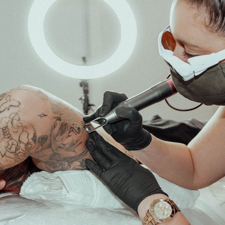 A Man Is Getting His Tattoo Removed — Beauty & Laser by Sarah in Long Jetty, NSW
