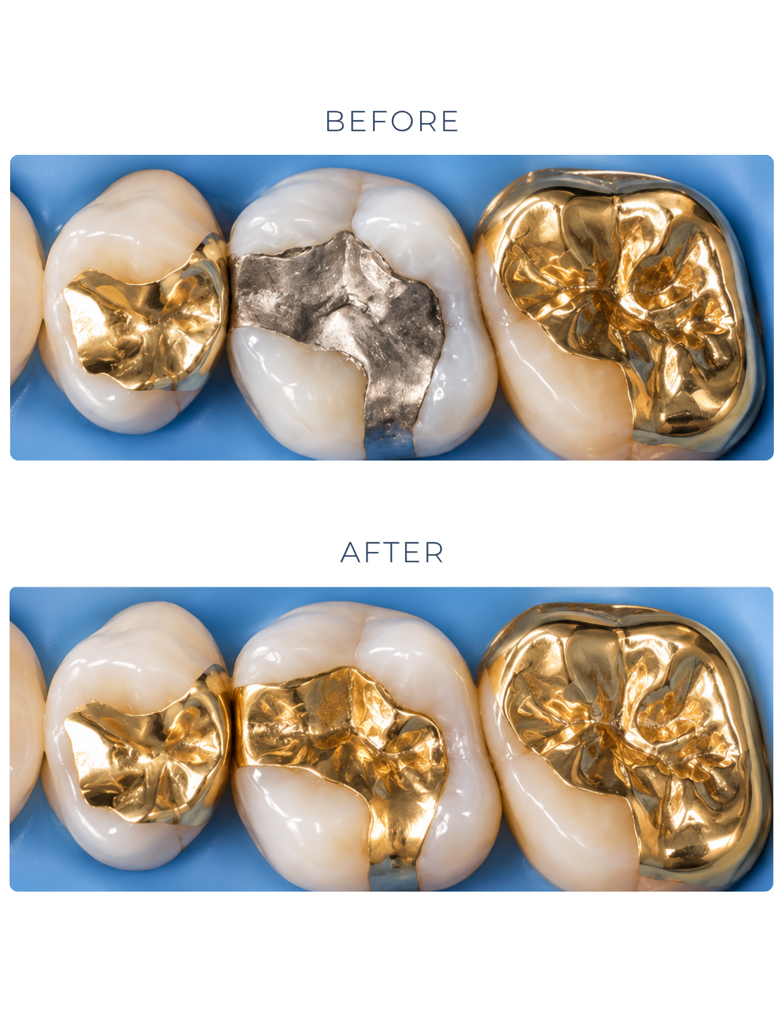 Before-and-after photos of gold dental fillings in molars on blue background