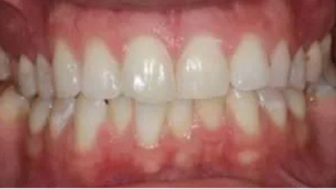 Close-up of teeth with pink gums and lips, showing a natural smile.