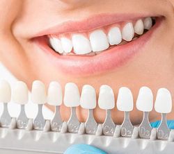 Dental shade guide matched to a smiling mouth, showing white teeth and color tabs