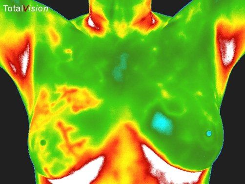 Before Breast Clearing — Hudson, NY — Serenity Wellness Medical Spa