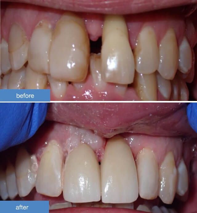 Dental Implants case 2